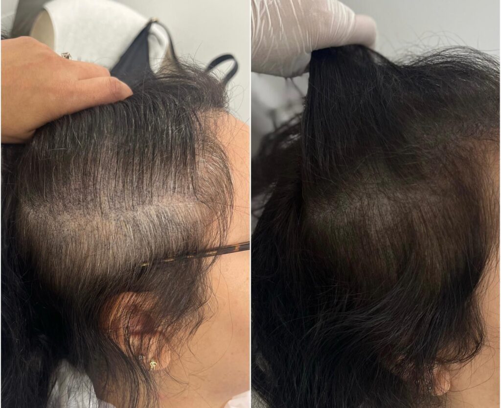 PRP Treatment in Pinner