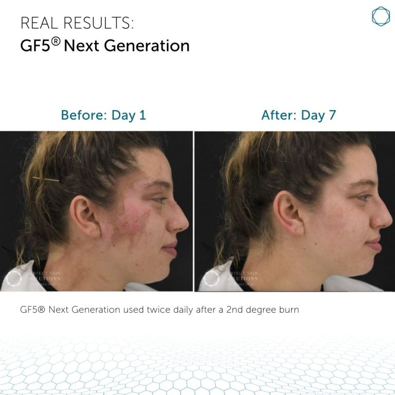 GF5 Next Generation® - Image 6