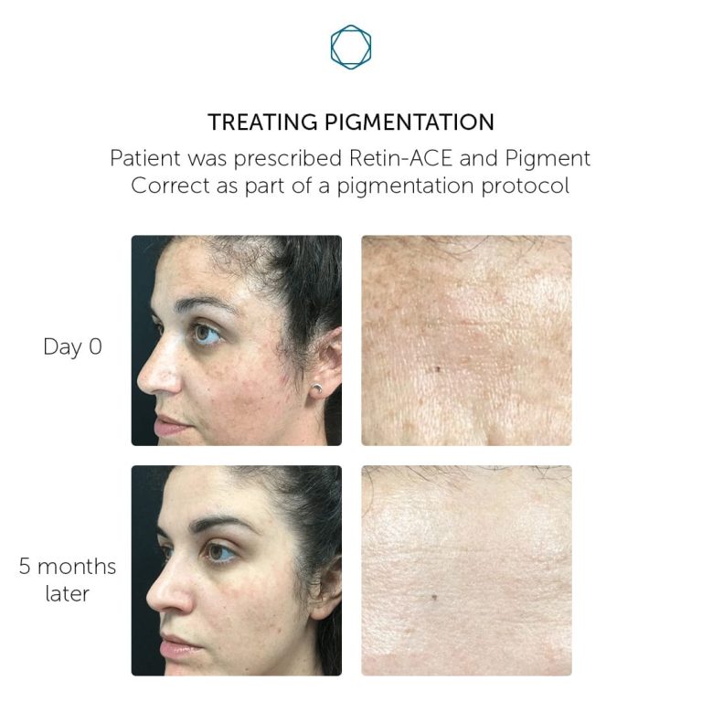 Pigment Correct (Inquire Now) - Image 3