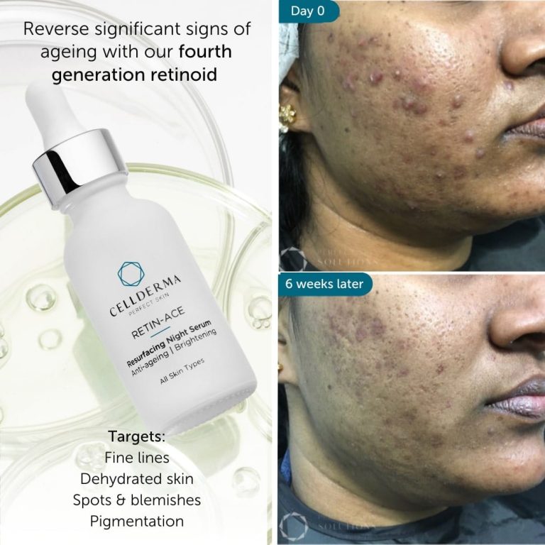 Retin-ACE® (Inquire Now) - Image 4