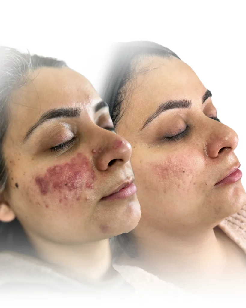 Acne Treatment in Harrow on the Hill