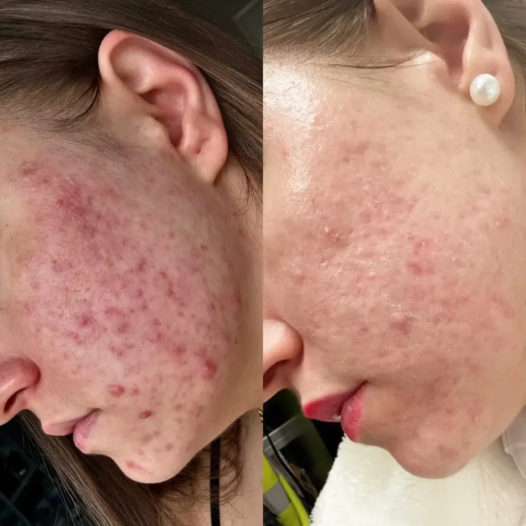 Acne Treatment in Edgware
